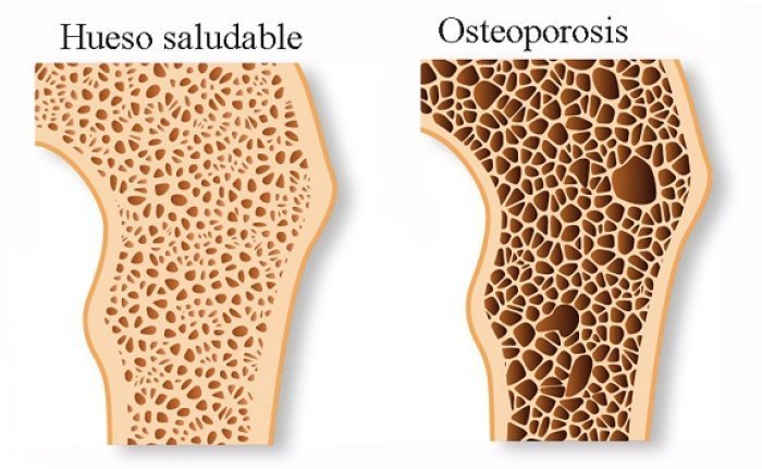 Cada tres segundos se registra una fractura de cadera o alguna extremidad asociada a la osteoporosis