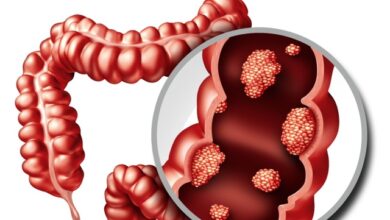 Detección oportuna de cáncer colorrectal reduce un 67% el riesgo de mortalidad