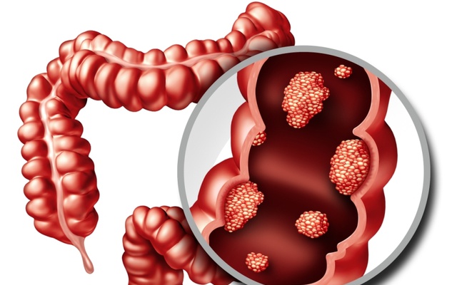 Detección oportuna de cáncer colorrectal reduce un 67% el riesgo de mortalidad